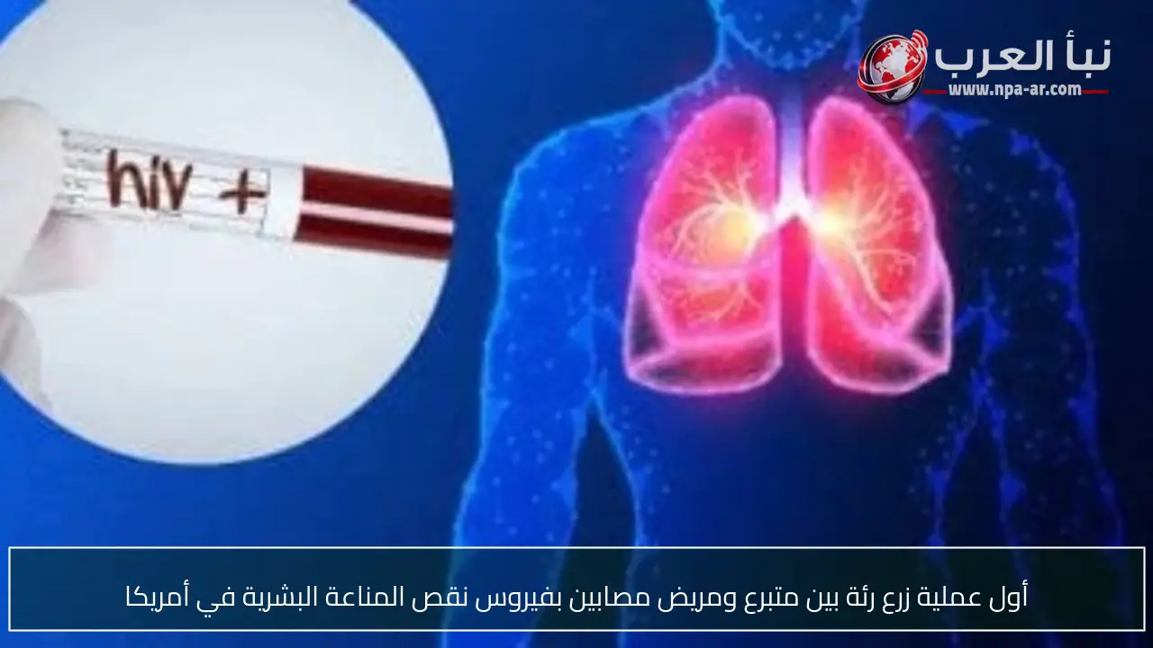 أول عملية زرع رئة بين متبرع ومريض مصابين بفيروس نقص المناعة البشرية في أمريكا