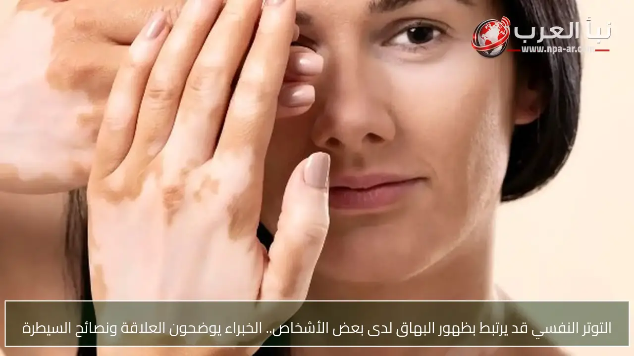 التوتر النفسي قد يرتبط بظهور البهاق لدى بعض الأشخاص.. الخبراء يوضحون العلاقة ونصائح السيطرة