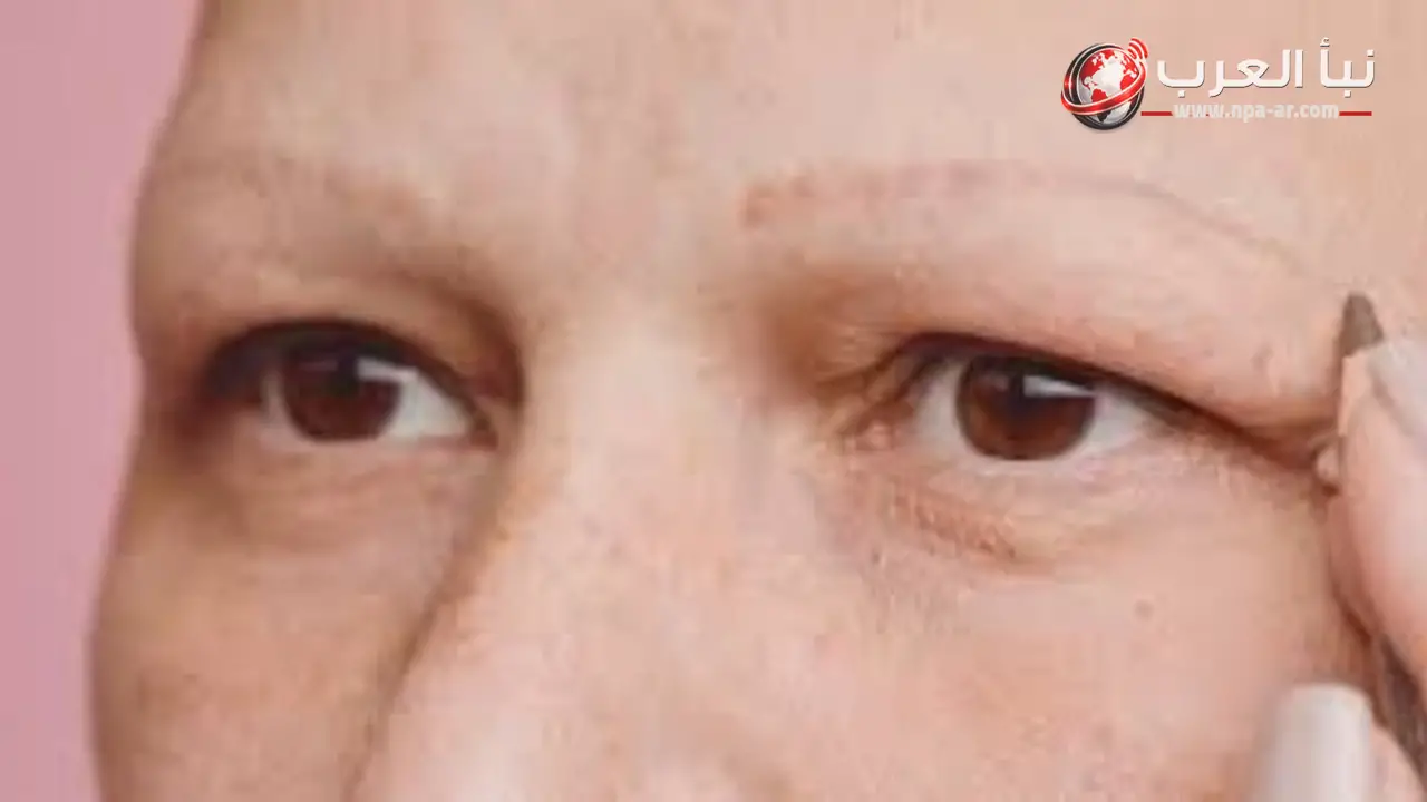 تساقط شعر الحواجب قد يشير إلى نقص عناصر أو اضطراب هرموني أو مرض مناعي